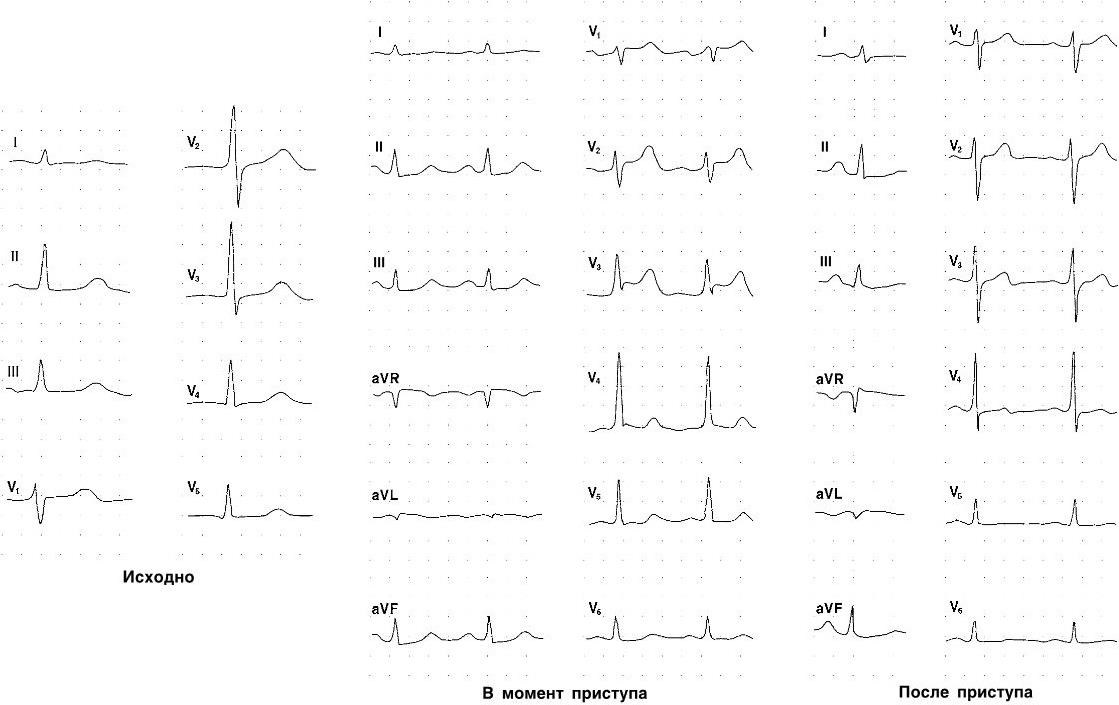 Экг в динамике что это. Элевация сегмента St на ЭКГ. ЭКГ элевация АВР. Элевация St в AVR на ЭКГ. Элевацией сегмента St заболевания.
