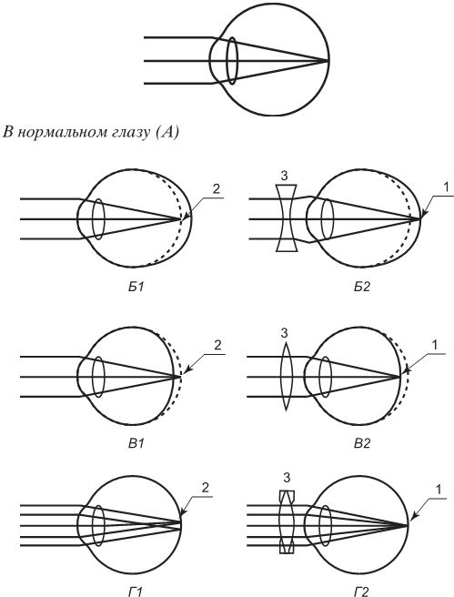 На рисунке приведены схемы хода лучей при близорукости и дальнозоркости